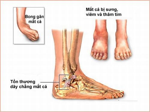 Tìm Hiểu Bong gân là gì & Xử Lý Khi bị bong gân Tìm Hiểu Bong gân là gì & Xử Lý Khi bị bong gân