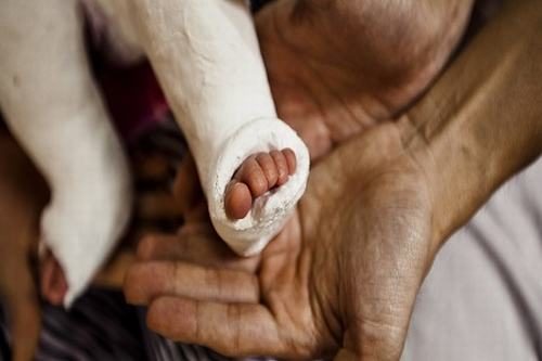Ở trẻ em, thời gian hồi phục thường nhanh hơn