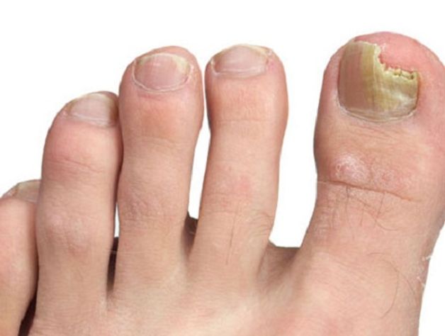 Bệnh móng chân thâm đen: Đôi khi, móng chân thâm đen có thể là một biểu hiện của vấn đề sức khỏe nghiêm trọng hơn. Tuy nhiên, với sự chăm sóc đúng cách, bạn có thể giảm thiểu tình trạng này và duy trì đôi chân khỏe đẹp. Hãy xem hình ảnh liên quan để biết thêm thông tin chi tiết về bệnh móng chân thâm đen.