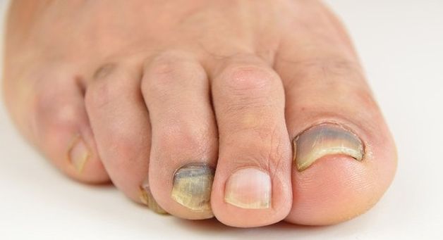 Móng chân bị đen là dấu hiệu của bệnh lý gì?