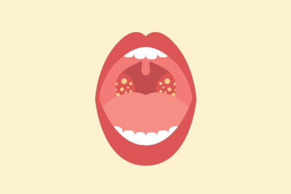 Viêm amidan là bệnh lý vùng họng thường gặp ở mọi đối tượng