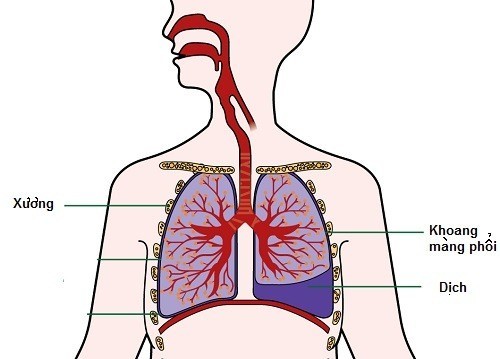 Tràn dịch màng phổi có thể gây biến chứng nguy hiểm cần được phát hiện sớm và điều trị hiệu quả