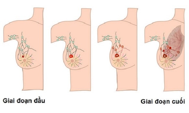 Nguyên nhân nổi hạch nách