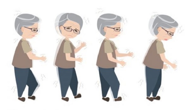 Tư thế của người mắc bệnh parkinson