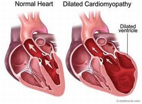 Bệnh viêm cơ tim và những điều cần biết