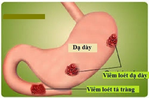 Viêm dạ dày tá tràng là một trong những bệnh lý đường tiêu hóa thường gặp