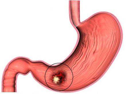 Viêm loét dạ dày tá tràng là một tổn thương hở xảy ra trên lớp niêm mạc dạ dày hoặc tá tràng. 