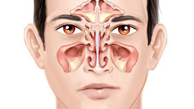 Bệnh viêm xoang mũi cấp tính có thể xuất phát từ nhiều nguyên nhân như nhiễm khuẩn do viêm mũi, viêm họng cấp tính