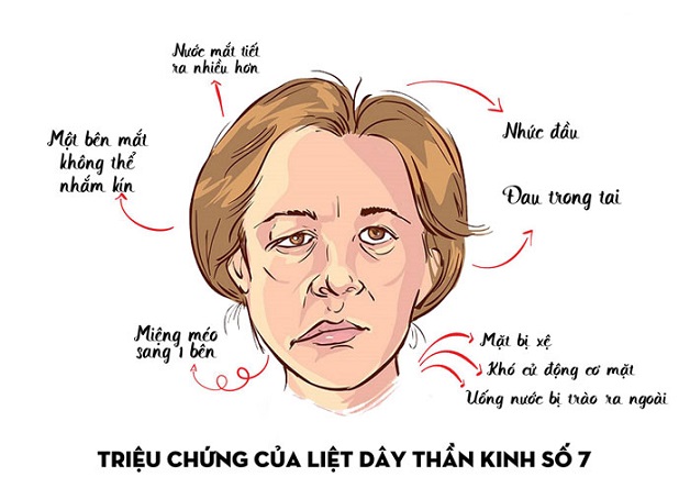 biểu hiện liệt dây thần kinh số 7