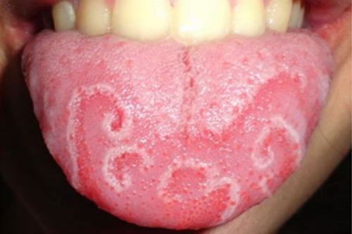 Top 7 các bệnh về lưỡi thường gặp bạn chớ coi thường