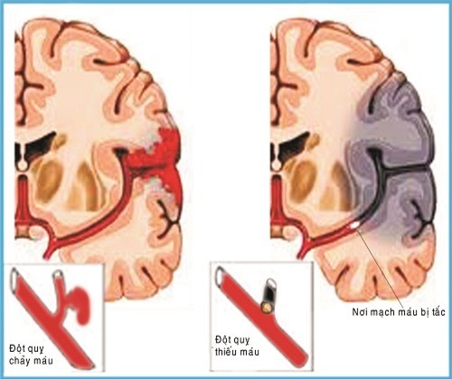 Chụp vi tính cắt lớp (CT) là kỹ thuật quan trọng giúp ghi lại hình ảnh não để xác định loại đột quỵ.