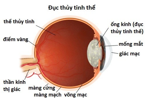 Khi protein tập trung thành đám, làm ánh sáng đi qua bị tán xạ, tạo ra những vùng mờ đục trong thủy tinh thể, cản ánh sáng đến võng mạc và giảm thị lực. 