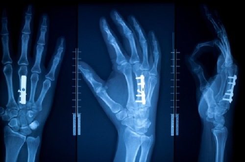 Chụp X quang giúp chẩn đoán xác định vị trí gãy xương và mức độ tổn thương