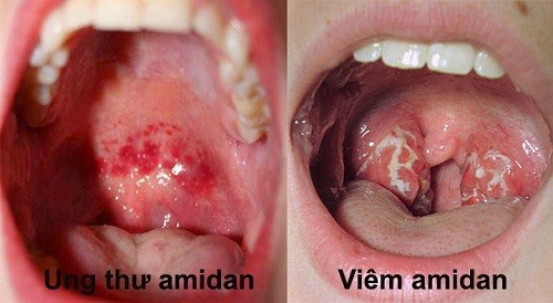 Ung thư amidan là bệnh thường gặp chiếm 13 - 15% trong ung thư vùng đầu - cổ.