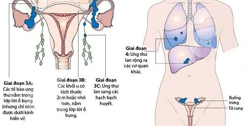 Hình ảnh ung thư buồng trứng này cho thấy bệnh đã di căn sang các bộ phận khác trong cơ thể