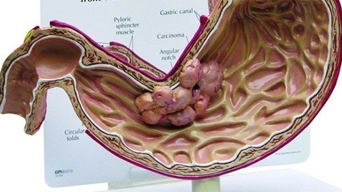 Hình ảnh ung thư dạ dày