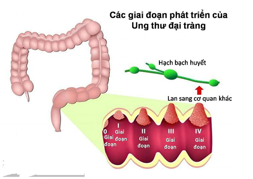 Hình ảnh ung thư đại tràng biến chứng nguy hiểm