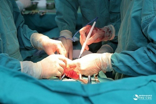 Phẫu thuật cắt bỏ tại chỗ là phương pháp được sử dụng để loại bỏ khối u ở hậu môn cùng với các mô lành xung quanh khối u. Phương pháp này được áp dụng ở bệnh nhân ung thư hậu môn giai đoạn sớm.