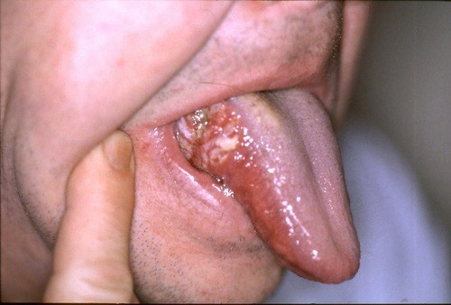 Ung thư lưỡi là bệnh ác tính có sự xuất hiện của khối u trên bề mặt hoặc đằng sau lưỡi, gần cổ họng
