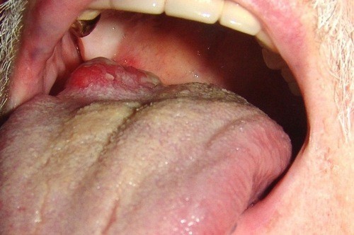 hình ảnh ung thư lưỡi khi tới giai đoạn nặng sẽ xuất hiện các u cục trên lưỡi