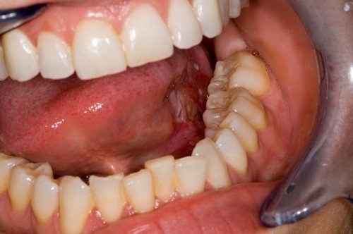 Khi bị ung thư lưỡi, người bệnh sẽ thấy xuất hiện các tổn thương viêm loét trên lưỡi , xuất hiện các niêm mạc trắng, chảy máu lưỡi không rõ nguyên nhân