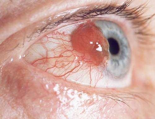 Hình ảnh ung thư mắt biến chứng nguy hiểm