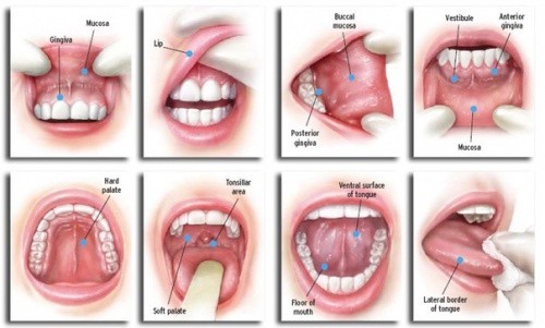 Hình ảnh ung thư miệng 1 - đây là loại u ác tính có thể xuất hiện ở bất kỳ vị trí nào trong khoang miệng bao gồm lưỡi, lợi hàm dưới, niêm mạc má…