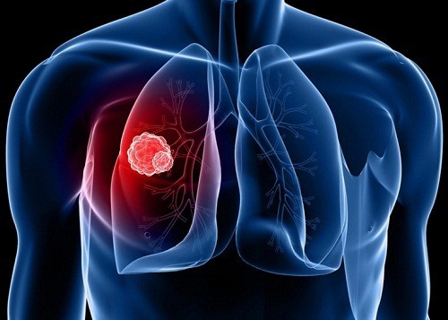 Những nỗ lực ngăn ngừa và chữa trị bệnh ung thư phổi ngày càng được cải thiện. Hãy cùng chiêm ngưỡng hình ảnh về các kỹ thuật y tế mới nhất trong việc chẩn đoán và điều trị ung thư phổi, giúp mang lại hy vọng cho những bệnh nhân đang mắc phải căn bệnh này.