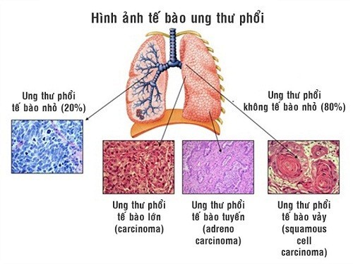 Dấu hiệu ung thư phổi ở nam giới như thế nào? | Doctor có sẵn