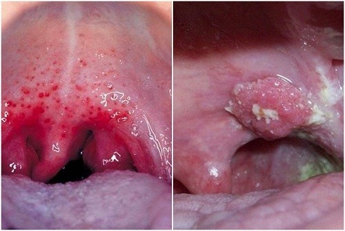 Hình ảnh ung thư vòm họng có mức độ nguy hiểm cao