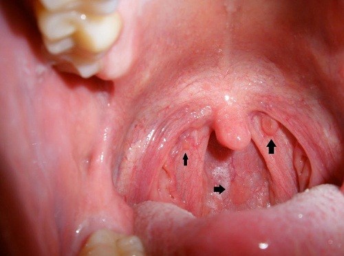 U xơ mạch vòm mũi họng Nguyên nhân chẩn đoán và điều trị