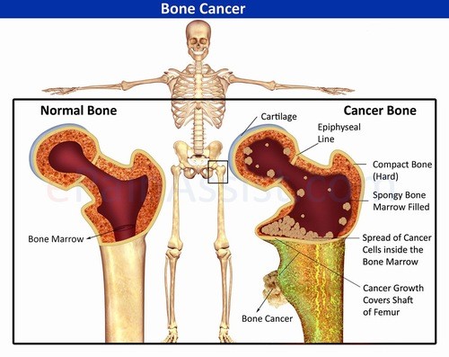 Hình ảnh ung thư xương có mức độ nguy hiểm cao