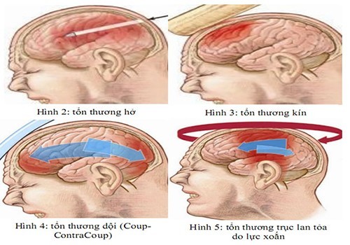 Để xác định mức độ bệnh, bác sĩ sẽ tiến hành khám lâm sàng (đặc biệt thông qua chuyển động mắt và đồng tử) cùng với kiểm tra cơ bản 