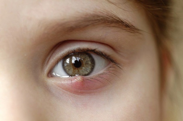 Lẹo ở mắt là bệnh do nhiễm trùng làm sưng nhọt trên mí mắt