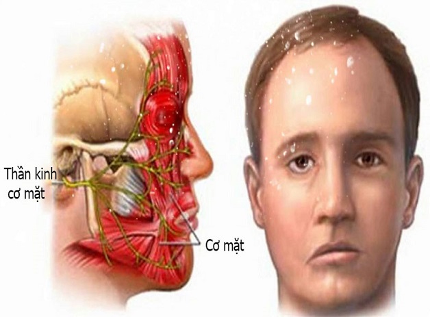 liệt dây thần kinh số 7 do nhiễm lạnh đột ngột