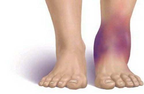 Những điều CẦN LÀM khi trật khớp mắt cá chân để Hồi Phục Nhanh 1 Những điều CẦN LÀM khi trật khớp mắt cá chân để Hồi Phục Nhanh 1
