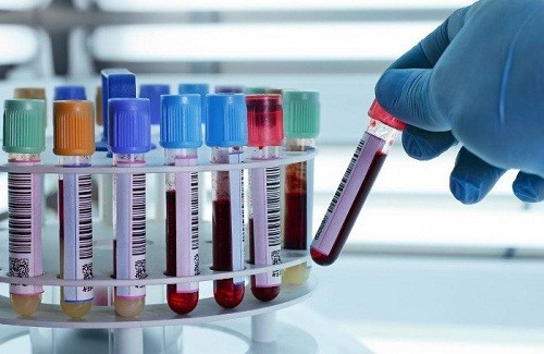 Xét nghiệm máu tìm kháng nguyên CEA là một phương pháp giúp phát hiện sớm ung thư đại tràng