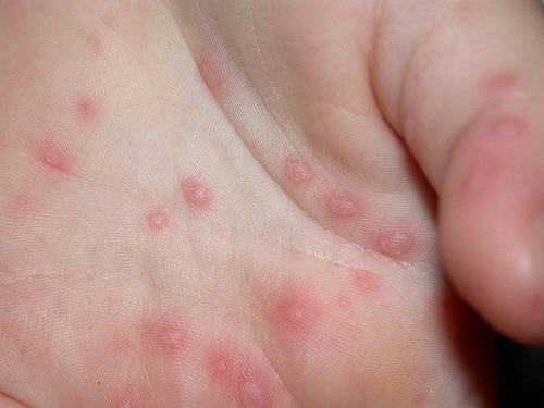 Bệnh tay chân miệng do vi khuẩn đường ruột Ente’virus (E71) và Coxcakieruses gây nên.