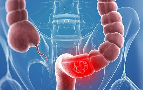 Viêm đại tràng co thắt hay còn gọi là hội chứng ruột kích thích.