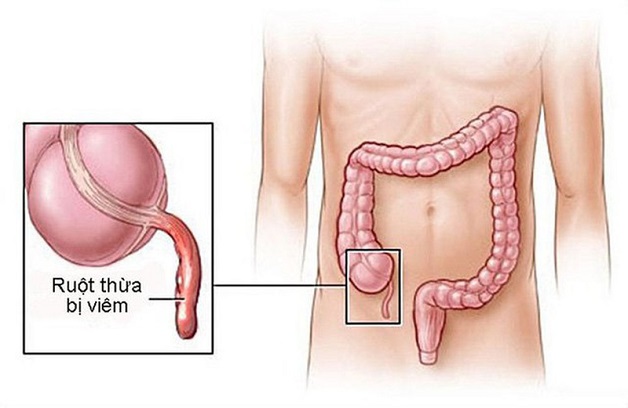Ruột thừa có tác dụng gì? 