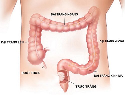 Viêm trực tràng nếu không điều trị kịp thời có thể tiến triển thành ung thư trực tràng
