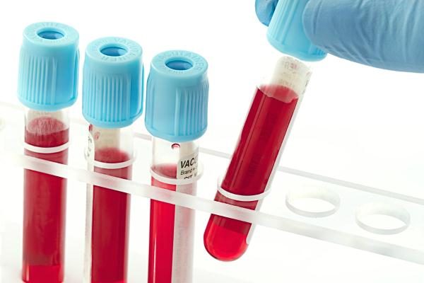 Để chẩn đoán chính xác sốt xuất huyết xét nghiệm máu là điều cần thiết.