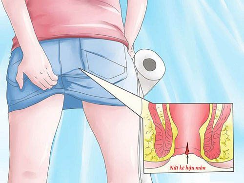 Nứt kẽ hậu môn là một dạng tổn thương xảy ra ở niêm mạc ống hậu môn
