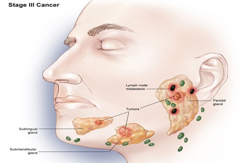 Biểu hiện ung thư tuyến nước bọt