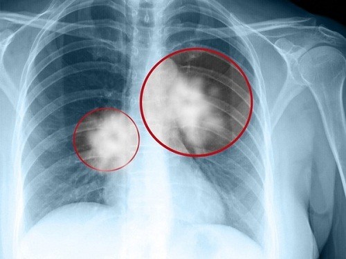 Chụp X-quang có phát hiện ung thư phổi không?