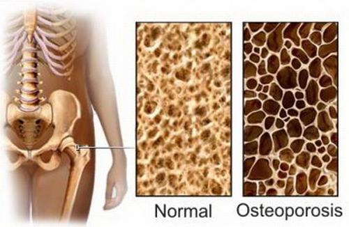 Loãng xương là tình trạng giảm sút sức mạnh của xương bao gồm khối lượng, mật độ xương