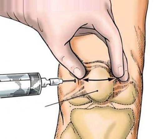 Trường hợp nào có thể chọc dò khớp gối? Trường hợp nào có thể chọc dò khớp gối?