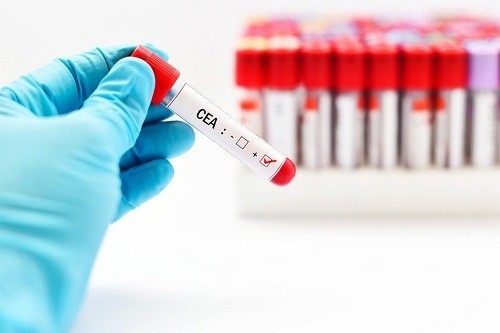 Định lượng CEA là một kháng nguyên có thể tìm thấy trong máu nhằm chẩn đoán sớm ung thư đại trực tràng và các loại ung thư khác