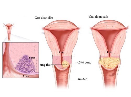 Ung thư cổ tử cung là bệnh lý nguy hiểm, thường gặp ở chị em phụ nữ.