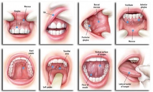 Hình ảnh ung thư miệng được thể hiện rõ trong bài viết này